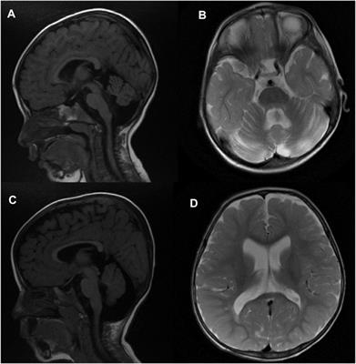 Case report: Birk–Landau–Perez syndrome linked to the SLC30A9 gene—identification of additional cases and expansion of the phenotypic spectrum